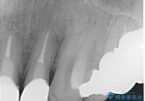 上の前歯の根元が黒い 根の治療を含めたセラミック再治療の治療後