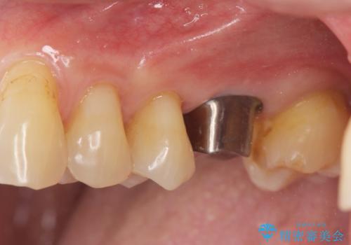 奥歯の欠損 インプラントによる咬合機能回復の治療中