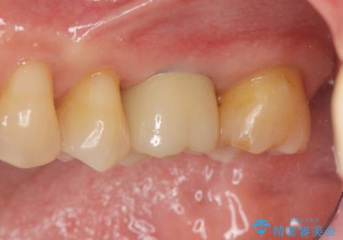 奥歯の欠損　インプラントによる咬合機能回復の症例 治療後