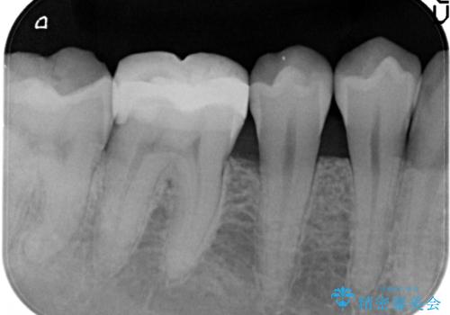 以前治療歯の中が虫歯になっている気がする セラミッククラウンによる再補綴の治療前
