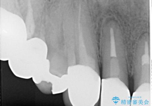 上の前歯の根元が黒い 根の治療を含めたセラミック再治療の治療後