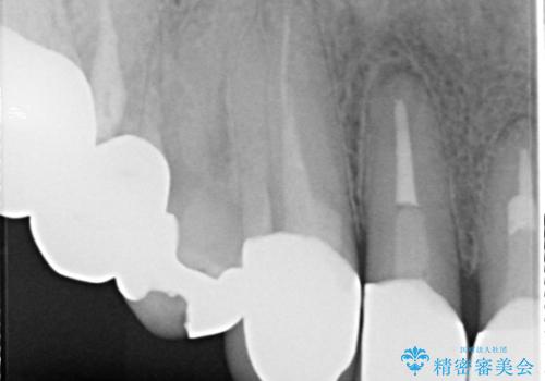 上の前歯の根元が黒い　根の治療を含めたセラミック再治療の治療後