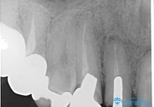 上の前歯の根元が黒い 根の治療を含めたセラミック再治療の治療前