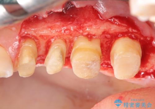 放置してしまった深い虫歯の治療の治療中