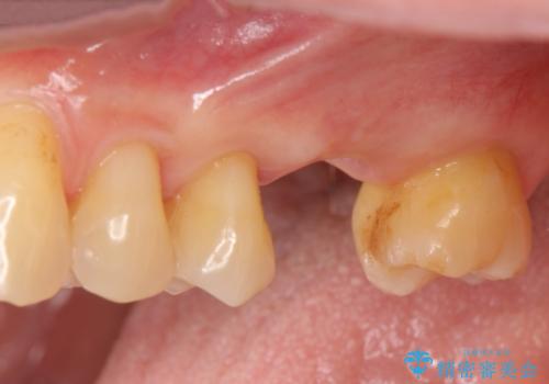 奥歯の欠損　インプラントによる咬合機能回復の治療前