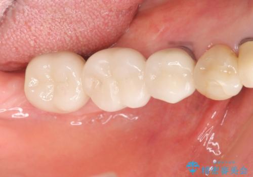 [遊離歯肉移植]  インプラント周囲の角化歯肉の獲得の治療後