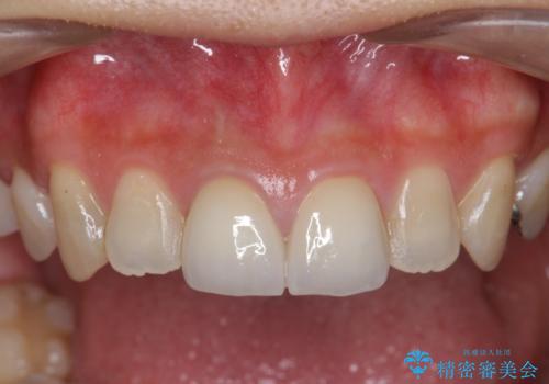 前歯 審美改善セラミック治療の治療後