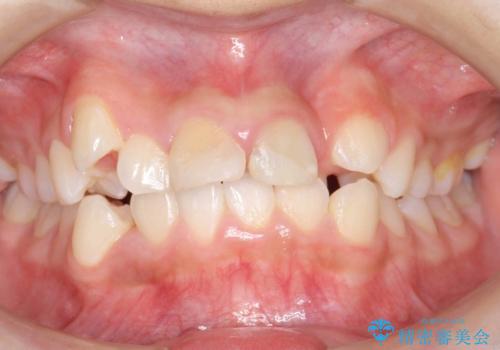 小さいころに前歯を折った　がたがたの矯正+変色した前歯をセラミックにの症例 治療前