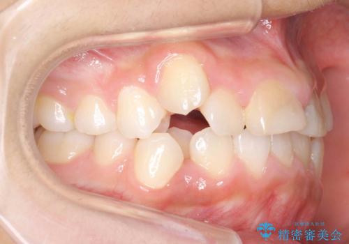 小さいころに前歯を折った がたがたの矯正+変色した前歯をセラミックにの治療前