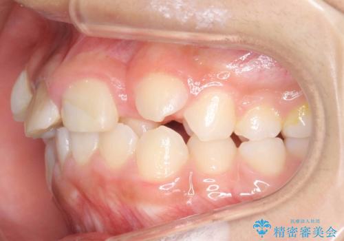 小さいころに前歯を折った　がたがたの矯正+変色した前歯をセラミックにの治療前