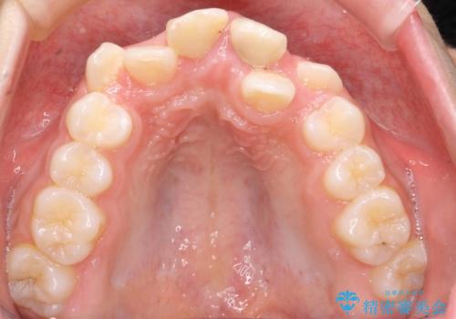 小さいころに前歯を折った がたがたの矯正+変色した前歯をセラミックにの治療前