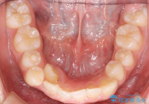 小さいころに前歯を折った　がたがたの矯正+変色した前歯をセラミックにの治療前