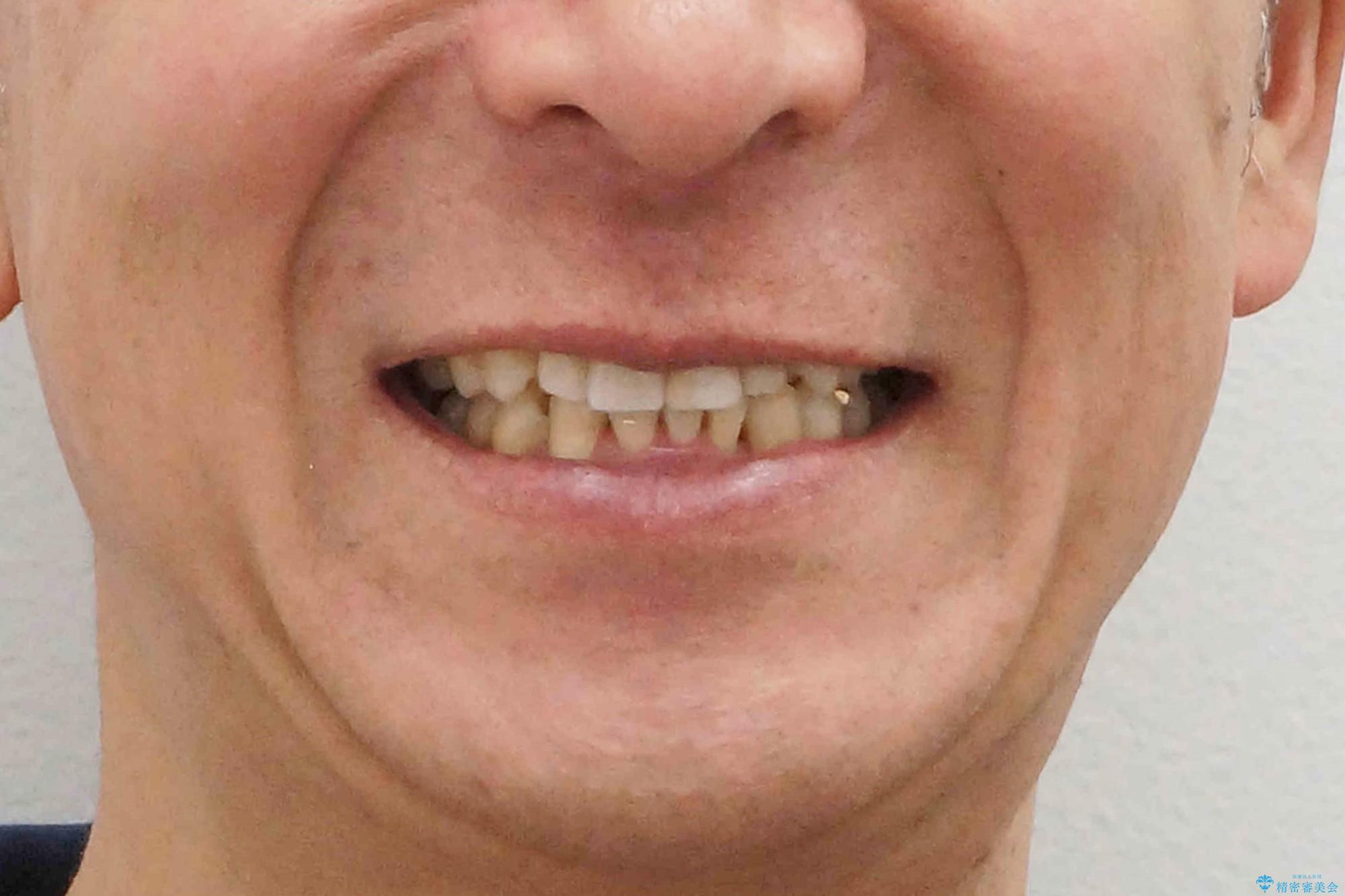 奥に引っ込んでいる歯をセラミックでかぶせたい　補綴前矯正　50代男性の治療後（顔貌）