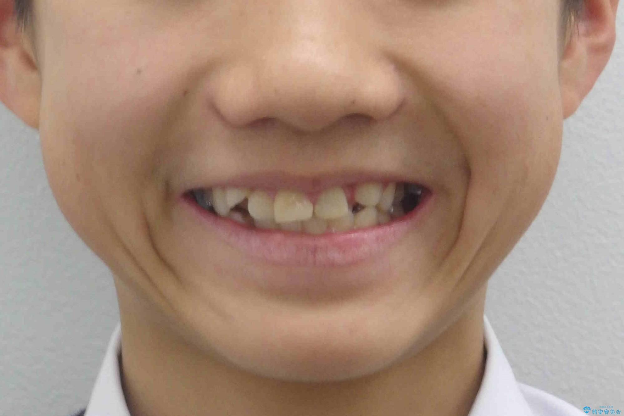 小さいころに前歯を折った がたがたの矯正+変色した前歯をセラミックにの治療前(顔貌)