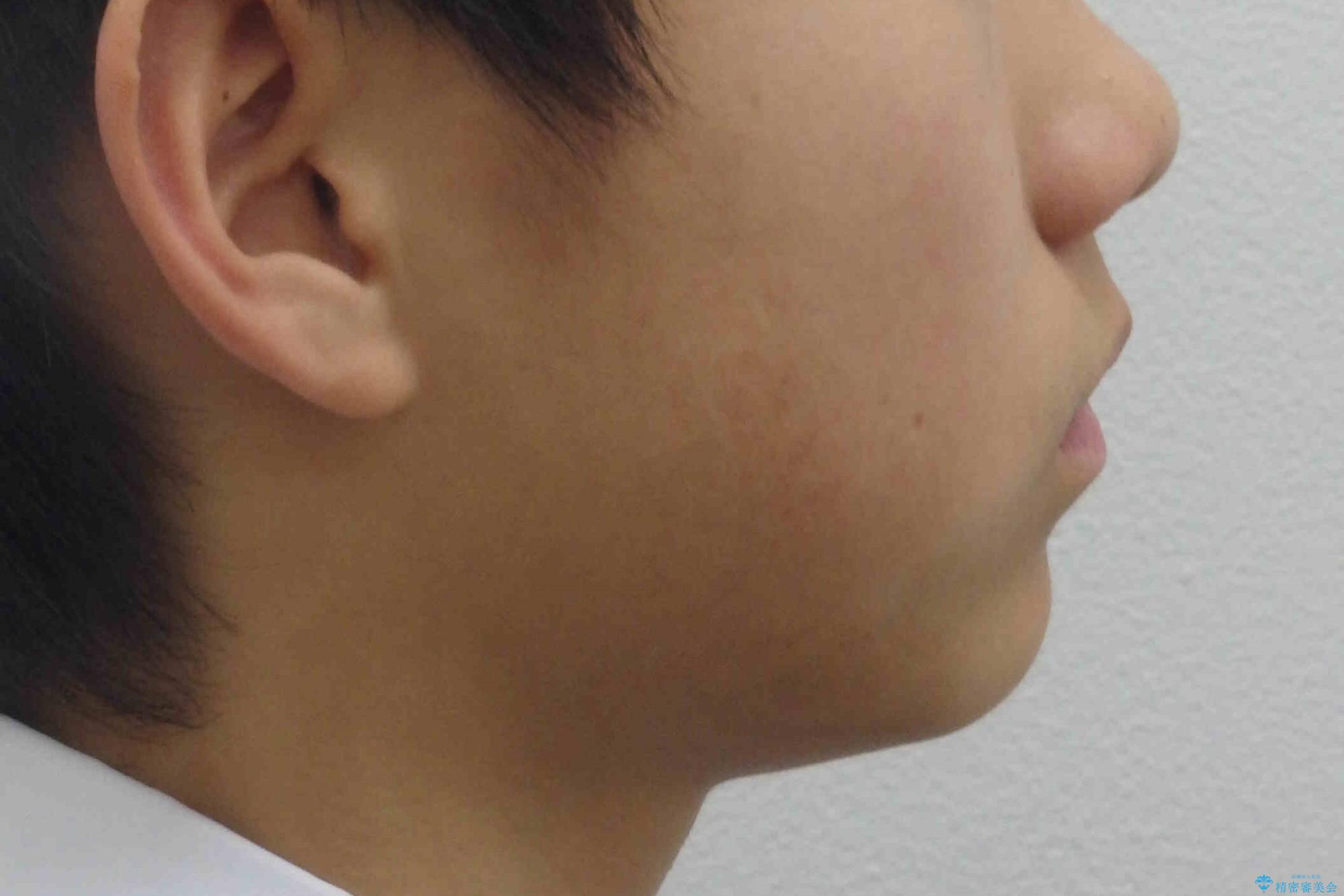 小さいころに前歯を折った がたがたの矯正+変色した前歯をセラミックにの治療前(顔貌)