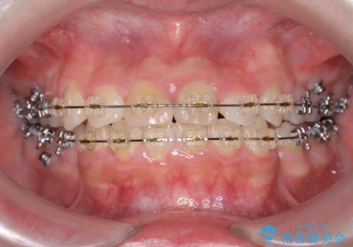 小さいころに前歯を折った　がたがたの矯正+変色した前歯をセラミックにの治療中