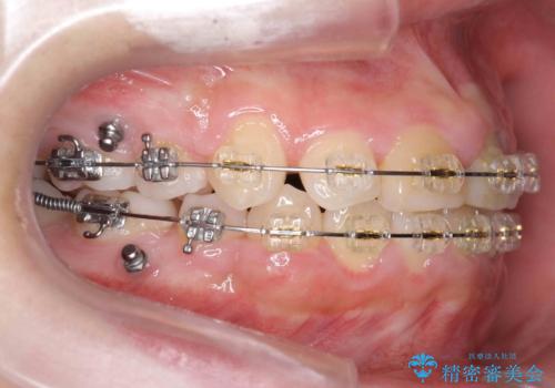 小さいころに前歯を折った がたがたの矯正+変色した前歯をセラミックにの治療中