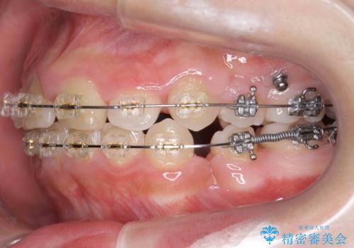 小さいころに前歯を折った がたがたの矯正+変色した前歯をセラミックにの治療中