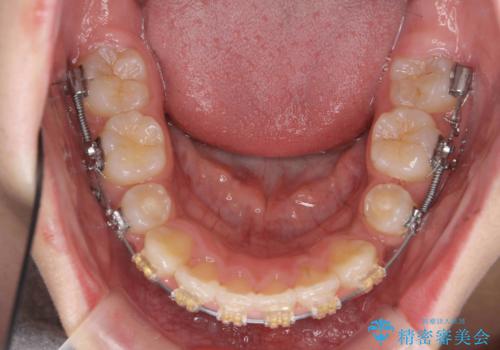 小さいころに前歯を折った　がたがたの矯正+変色した前歯をセラミックにの治療中