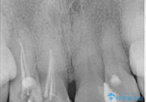 変色した前歯のオールセラミック治療の治療前
