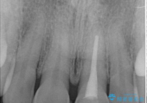 オールセラミッククラウン 変色が気になる前歯の治療の治療前