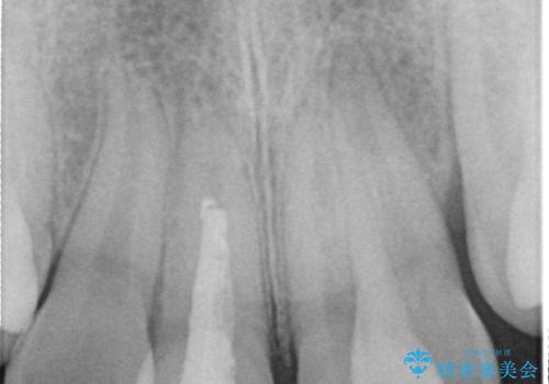小さいころに前歯を折った がたがたの矯正+変色した前歯をセラミックにの治療前