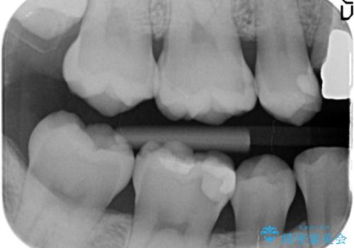 セラミックインレー　しみる歯の歯の治療の治療前