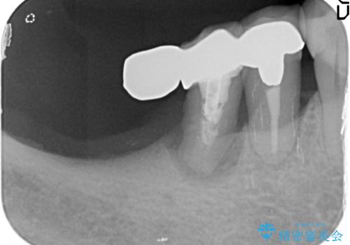 [遊離歯肉移植]  インプラント周囲の角化歯肉の獲得の治療前