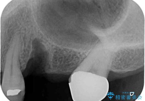 部分矯正を併用した奥歯のインプラント補綴治療の治療前