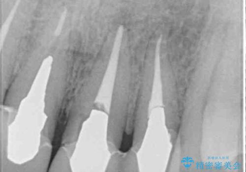 歯が痛い 前歯のセラミック治療の治療前