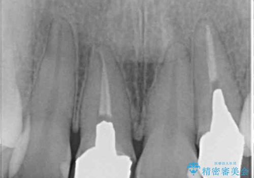 裏打ちが金属のセラミッククラウンをオールセラミッククラウンで自然にの治療前
