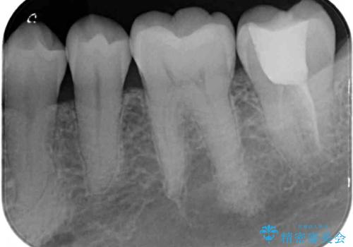 奥歯が割れた 神経が取り除かれた歯のセラミッククラウン治療の治療前