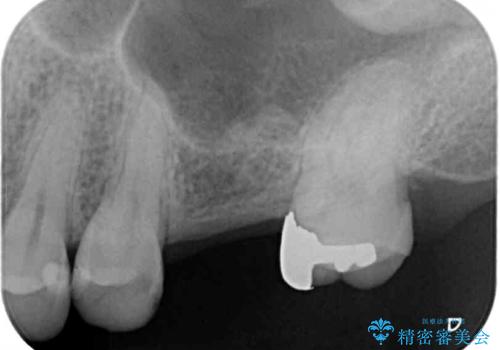 インビザライン矯正とインプラント補綴 深い咬み合わせと奥歯の欠損治療の治療前
