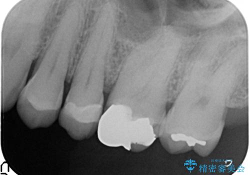 オールセラミッククラウン 欠けた歯の治療の治療前