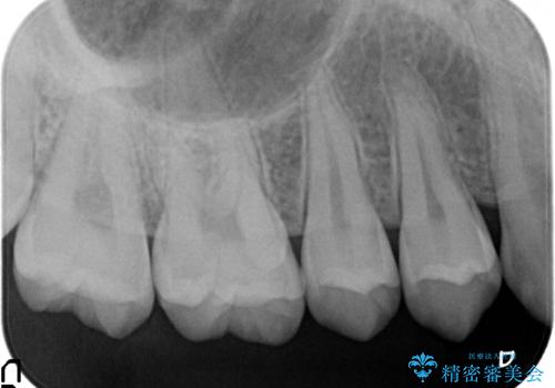 検診による初期虫歯の早期発見・早期治療の治療前