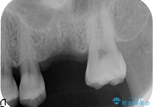 奥歯の欠損　インプラントによる咬合機能回復の治療前