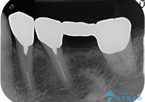 老朽化したブリッジのやりかえの治療前