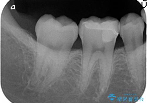 セラミックインレー　しみる歯の歯の治療の治療後