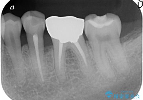 臼歯　咬合の再構成の治療前