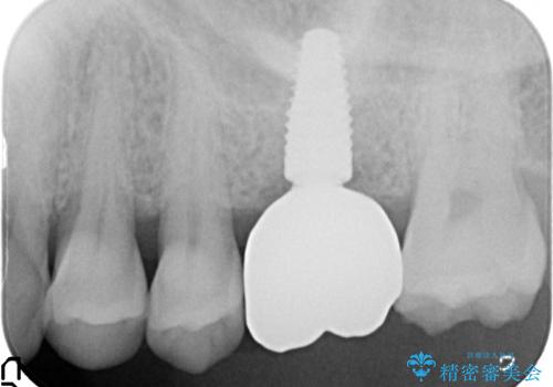 奥歯の欠損 インプラントによる咬合機能回復