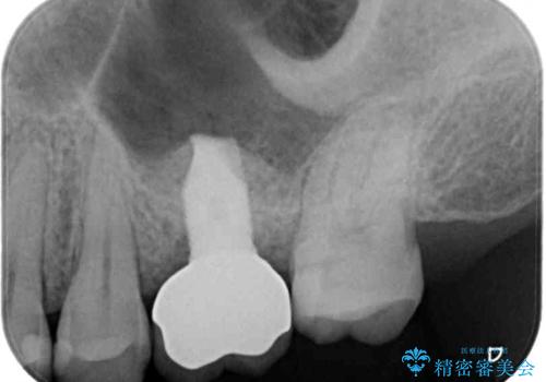 インビザライン矯正とインプラント補綴 深い咬み合わせと奥歯の欠損治療の治療後