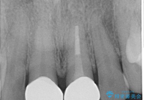 オールセラミッククラウン 変色が気になる前歯の治療の治療後