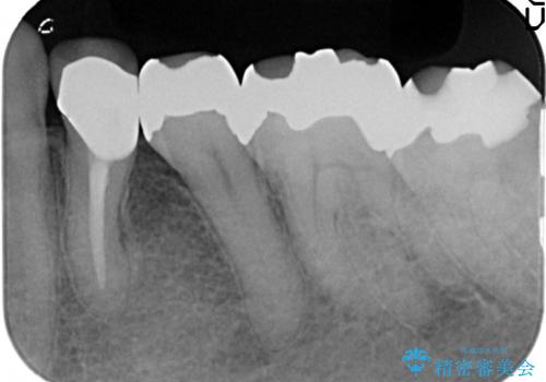 オールセラミッククラウン 疼きの治まらない歯の治療の治療後
