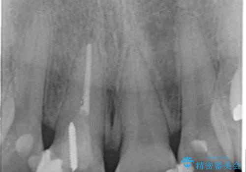 前歯 審美改善セラミック治療の治療前