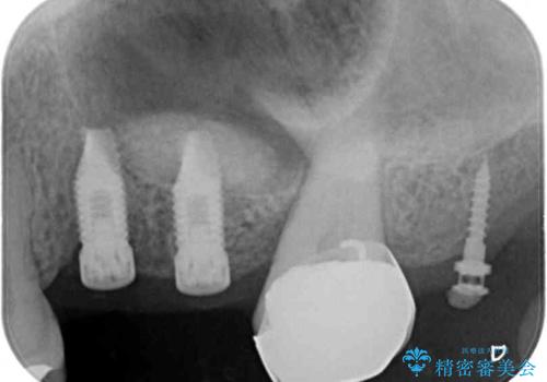 部分矯正を併用した奥歯のインプラント補綴治療の治療中