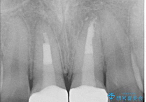 小さいころに前歯を折った がたがたの矯正+変色した前歯をセラミックにの治療後