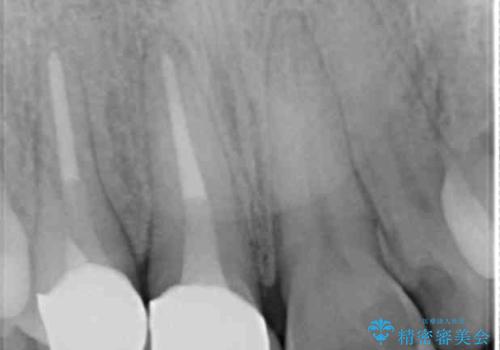 奥に引っ込んでいる歯をセラミックでかぶせたい 補綴前矯正 50代男性の治療後