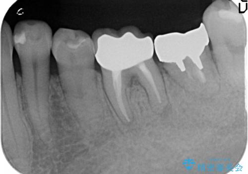 オールセラミッククラウン 外れてしまった銀歯の治療の治療後