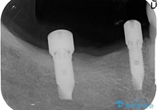 [遊離歯肉移植]  インプラント周囲の角化歯肉の獲得の治療中