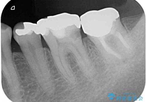 奥歯の虫歯と歯茎の腫れをセラミッククラウンで治療の治療前